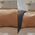 drainage-lymphatique-avant-apres