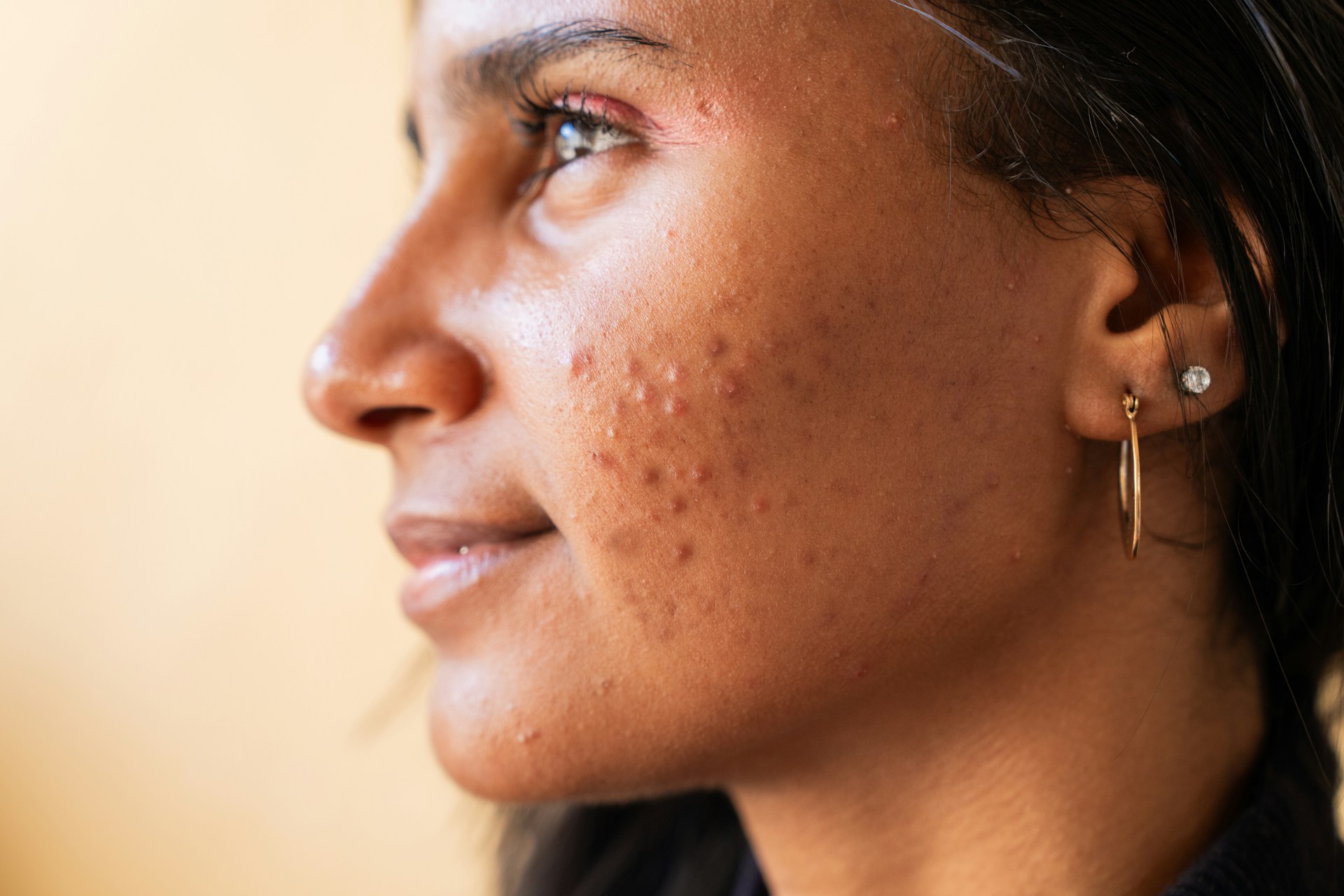 pores dilatés que faire pores dilatés que faire