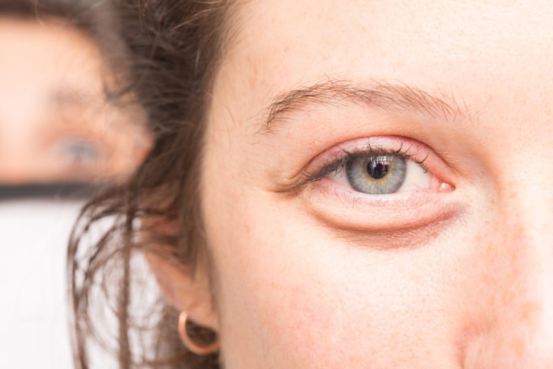 poche-sous-yeux