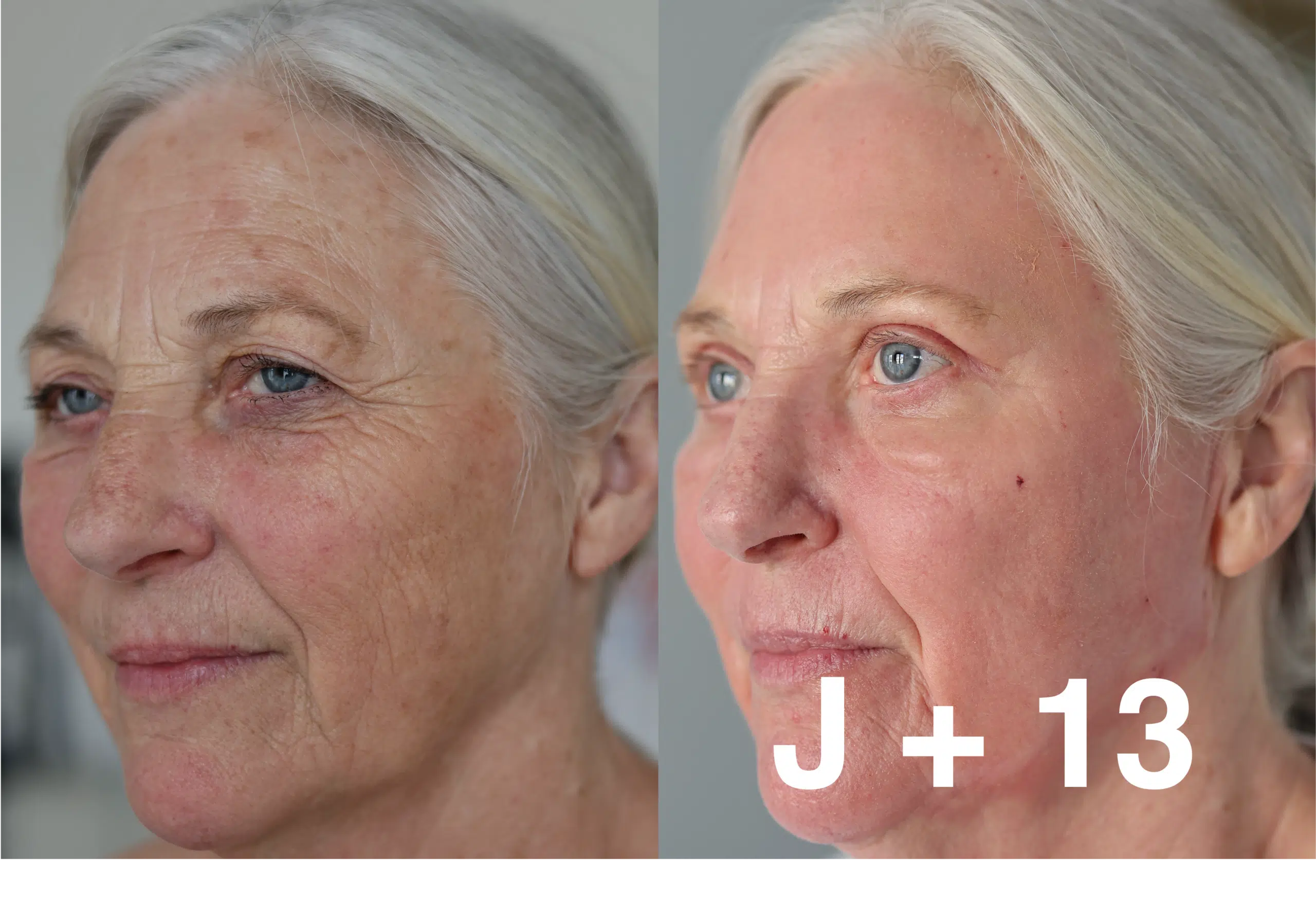 laser co2 visage avant apres laser co2 visage avant apres