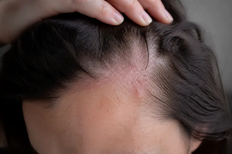 Irritation cutanée légère près de la racine des cheveux, pouvant résulter de certains traitements capillaires mal tolérés.